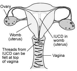 IUD in place